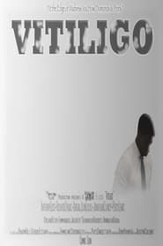 Vitiligo (2017)