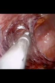 Image Laparoscopic Surgery
